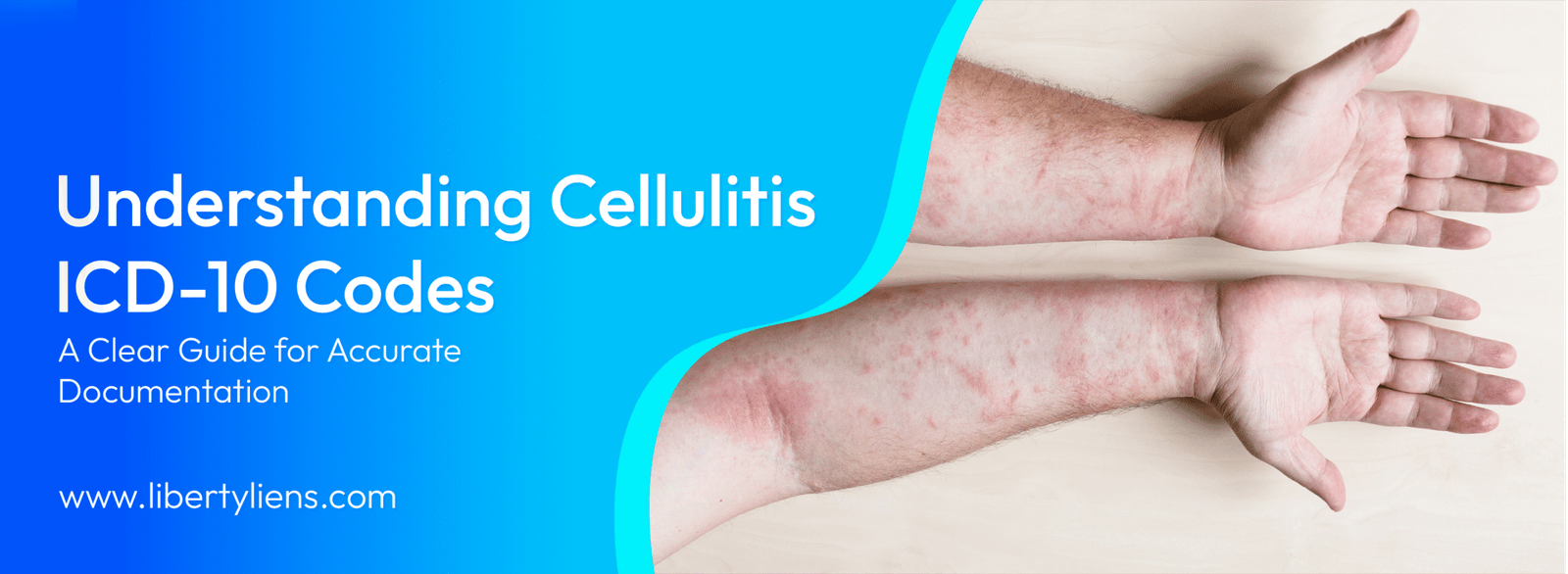 Cellulitis ICD-10 Codes